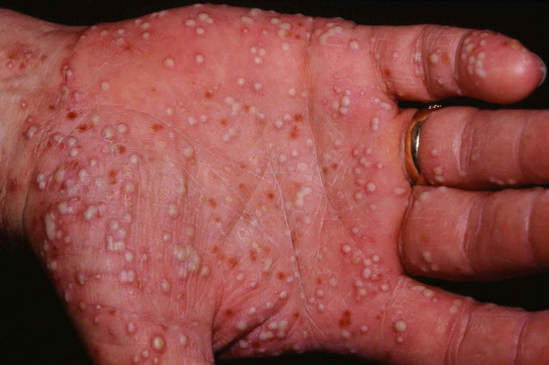 palmoplantar pustulosis on hand