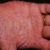 palmoplantar pustulosis on hand