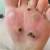 getting rid of plantar warts