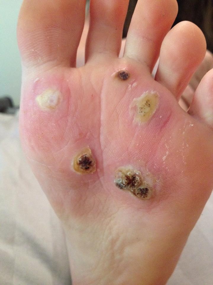 getting rid of plantar warts