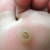 plantar wart