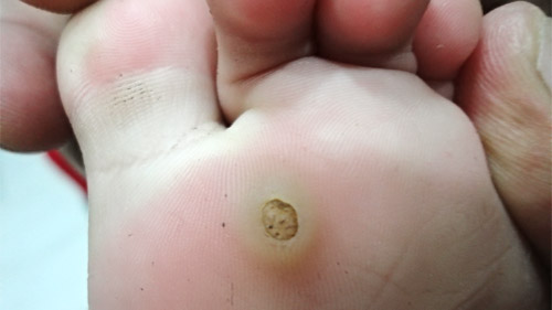 plantar wart