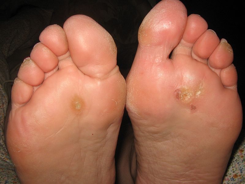 getting rid of plantar warts