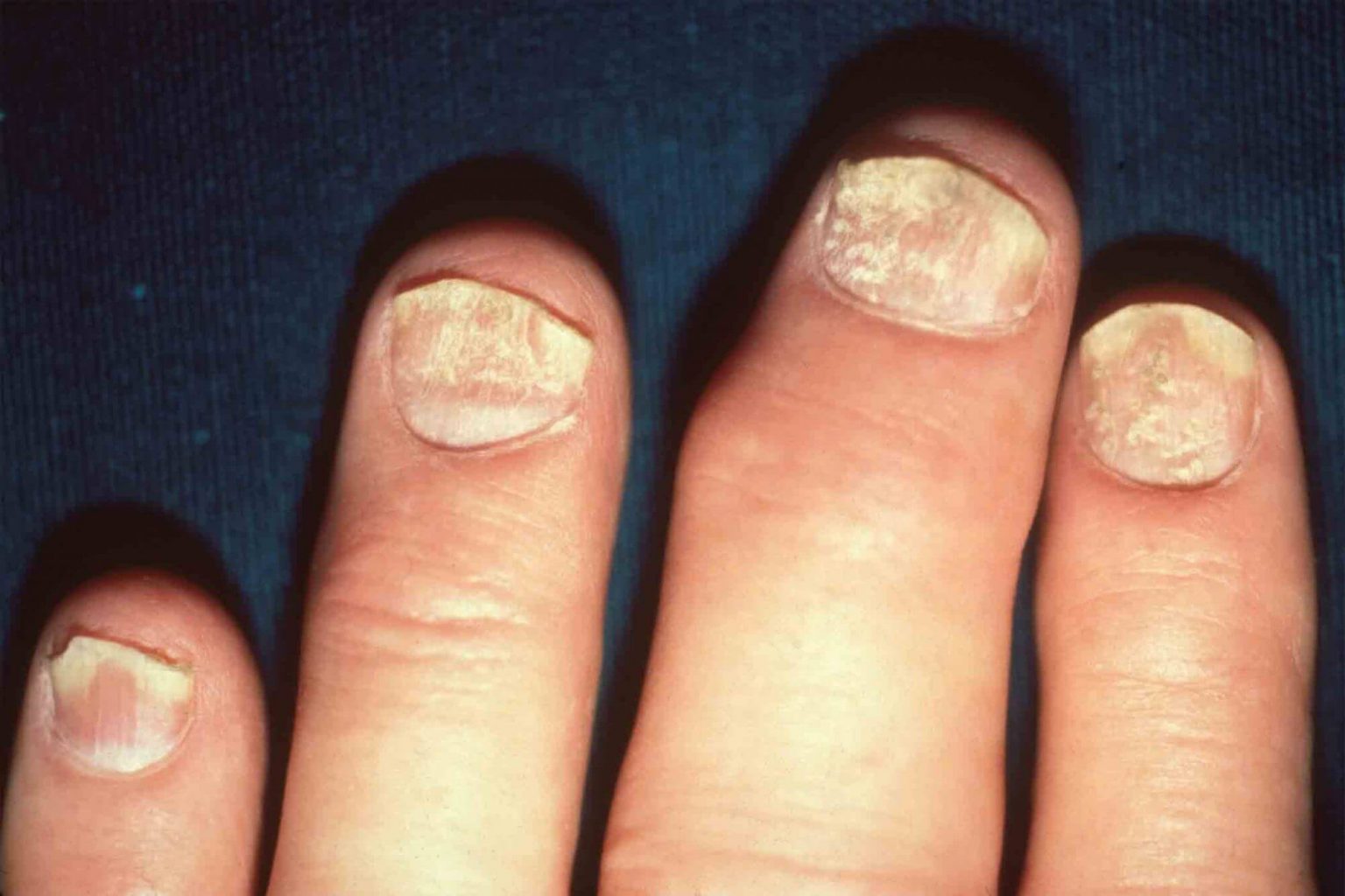 Can Nail Psoriasis Be Cured 4 Best Nail Psoriasis Treatment Options Be Your Best Well Self