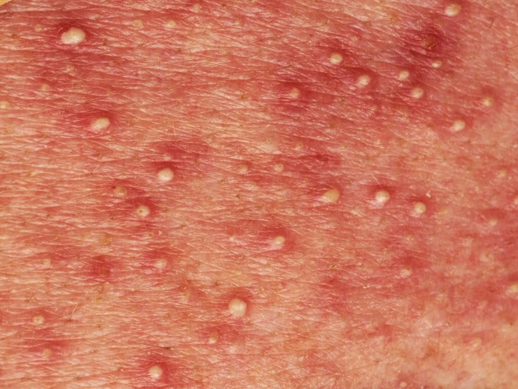 pustular psoriasis