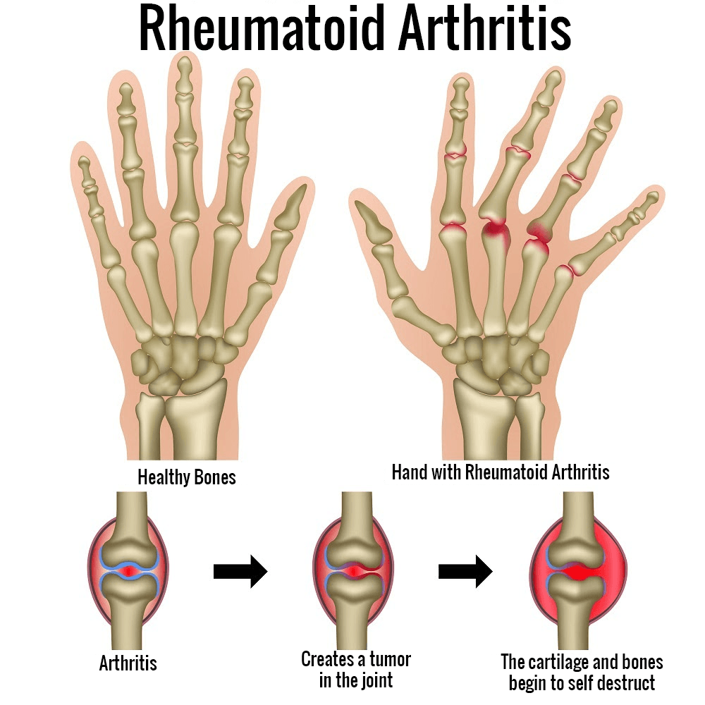 Rheumatoid Arthritis