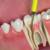 Root Canal Treatment