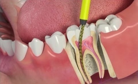 Root Canal Treatment