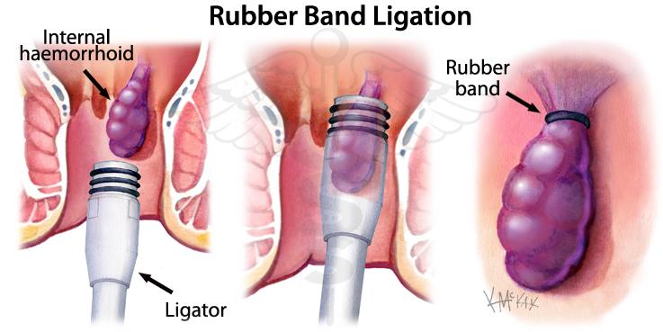 Rubber band ligation
