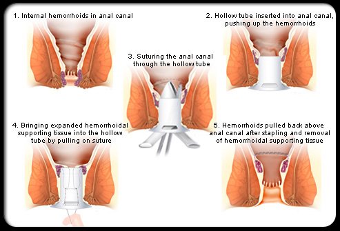stapled hemorrhoidectomy