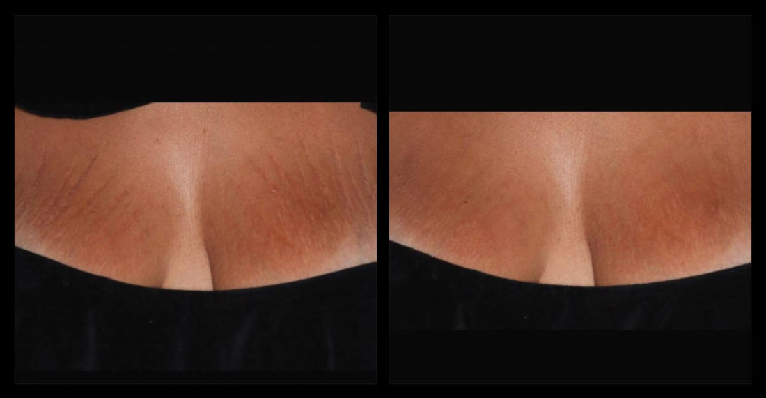 laser treatment for stretch marks before and after