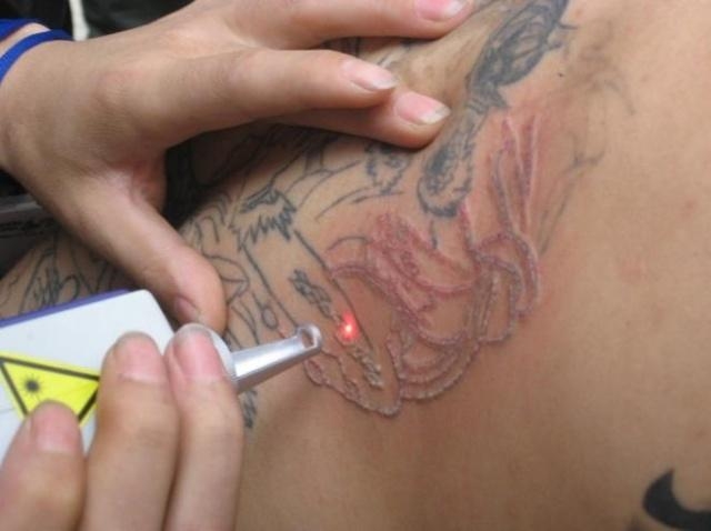 Debunking the Myth of Tattoo Removal