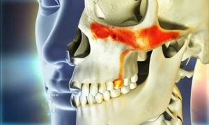 toothache from sinusitis