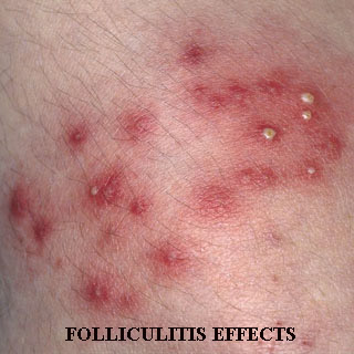 Gram-Negative Folliculitis
