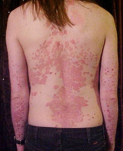 types of psoriasis