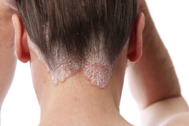 Seborrheic dermatitis